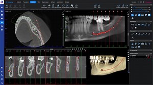 How to – Mark mandibular nerve to a CBCT image in Planmeca Romexis