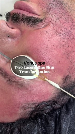 Dual Laser Skin Reset: Fraxel 1550 Ultra MD 1927 At Venus Spa I combine Fraxel 1550 Laser with Ultra MD Laser 1927 in the same session. 1550 goes deep to rebuild collagen, improve scars, stretch marks, and wrinkles. 1927 works superficially to erase sun damage, pigmentation, and uneven tone. Two layers of the skin treated at once: ✨ Dermal remodeling ✨ Pigment correction ✨ Texture refinement ✨ Real skin regeneration Not just a facial. A full skin reset. #Fraxel1550 #UltraMDLaser