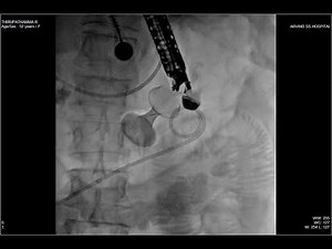 EUS GASTROJEJUNOSTOMY - FREEHAND TECHNIQUE