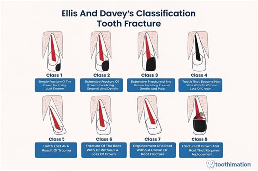 Dr. Zeba Naz on Instagram: "“Tooth trauma explained in one chart 🧠🦷 Ellis & Davey’s classification – a must for NEET MDS!”"