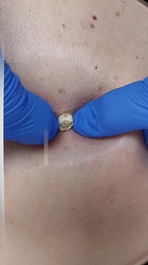 Effective Blackhead and Pimple Removal Techniques