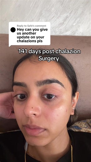 141 Days Post Chalazion Surgery Update