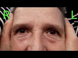 The positive HIT test in the patient with AUVP on the left side| Practical Neuro-otology