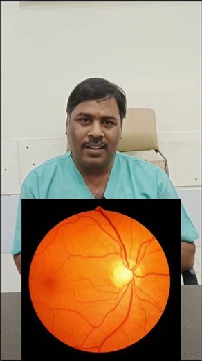Hole in Retina? Watch This Before LASIK!#viral #shorts #eyes # LASIK # health