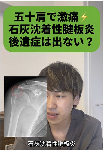 五十肩と石灰沈着性腱板炎の治療法解説