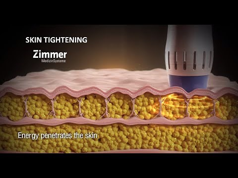 Skin Tightening and Body Contouring - Z Wave by Zimmer (Medical Device 3D Animation)