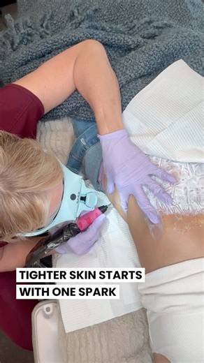 3 comments | The results I’m getting with Scar & Stretchmark Revision...