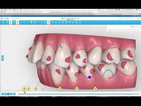 インビザラインの治療シミュレーションと治療計画｜盛岡市高橋衛歯科医院
