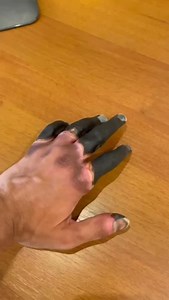 Deep frostbite and how to avoid it… | Mahyar "Max" Maddahali, MD