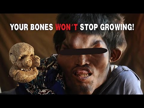 Why This Condition Makes Growing a NIGHTMARE! - Proteus Syndrome