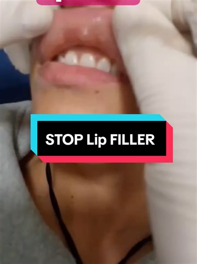 Migrated filler? Causes of lip filler migration: An excessive amount of filler/ Incorrect or poor injection technique/Rarely, your body may react unexpectedly to the filler. It's important to remove the migrated filler before reshaping lips with more hyaluronic acid. #foryo #hyaluronicacid #AestheticDoctor #fillerlips #hyaluronicacidfillers #hyaluronicacid