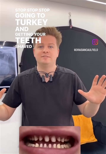 Stop going to Turkey to get your teeth shaved ⛔️‼️ Posted this to my story a while back, just wanted to highlight the importance of what you are doing when going abroad for dentistry Problems with joined up “Turkey teeth veneers” ❌ Can’t clean your gums as they’re joined up = gum disease ❌ Root canal healthy teeth = shortened life span of tooth ❌ Having to fly back every time you have a problem ❌ £££££ over £20,000 to fix ❌ Irreversible damage - tiny stumps are close to nerve = pain Benefits of 