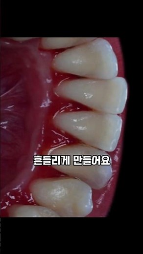 치석 제거 영상, 예방법과 관리법