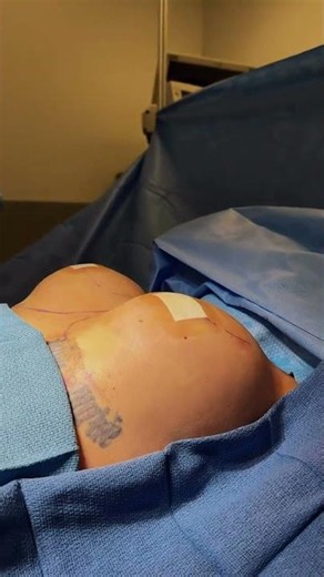 Preservé Breast Augmentation Results by Dr. Arredondo