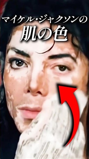 映画でも描かれたマイケル・ジャクソンの尋常性白斑