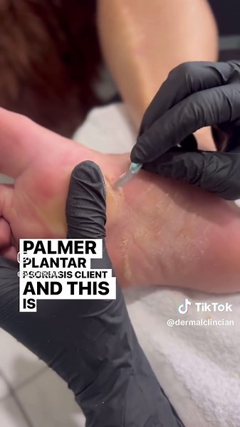 Palmar Plantar Psoriasis Treatment