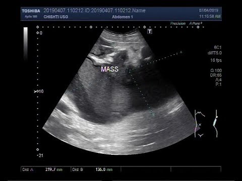 Ultrasound Video showing a large Renal Mass.