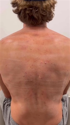 281K views · 367 reactions | ✨ Peel Acné My Laser : la solution...