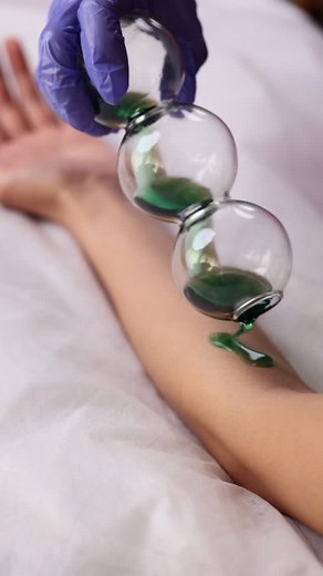 Hand pain relief cupping treatment . . . . . . . . . . . . Skincare | hair care | nails care | cupping Follow me for most advanced aesthetics treatments procedures Dm me for more queries Halina cupping clinic Chemicals free treatment Success is when I see my client smile. Our aim is to make a chemical free cosmetic treatment & long lasting results All 7 days working 10 am to 8.30 pm To book Appointment Chennai 8870482669 Dm for appointment ❌We are strictly not entertaining any injectables in ent