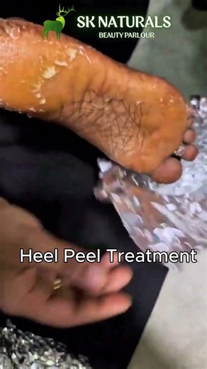 Heel Peel Treatment | Say Goodbye to Cracked Heels & Rough Feet Fast