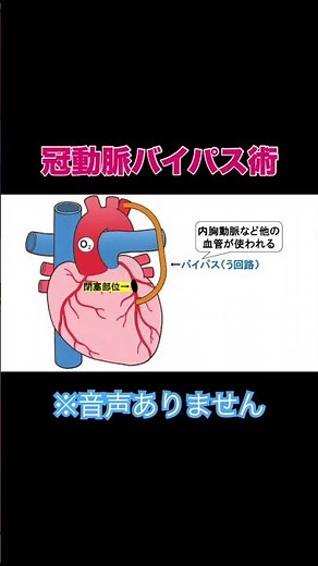 冠動脈バイパス術 #国試 #看護学生