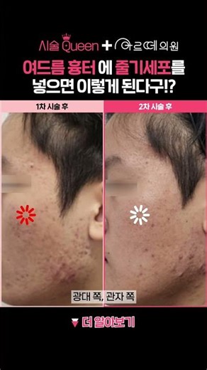 줄기세포 시술로 여드름 흉터가 이렇게?😱 실제 재생 변화 공개!