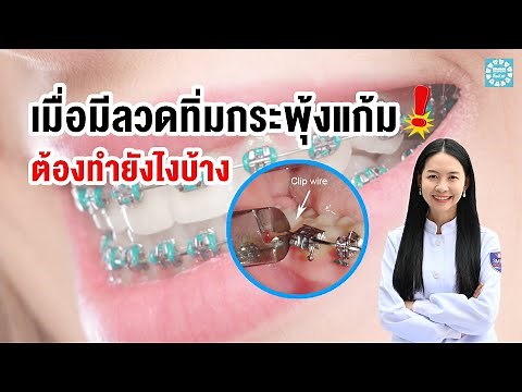 What to do if a wire is stuck in your cheek? | Dr. Ning has the answer