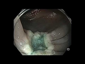 Colonoscopy: Rectal Polyp EMR - Large Sessile Polyp Resection • Video • MEDtube.net