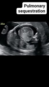 1K reactions · 215 shares | Pulmonary sequestration | Radiology Interesting Cases | Facebook