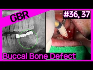 [Online Surgery] TSⅢ & KSⅢ implant placement using OneGuide