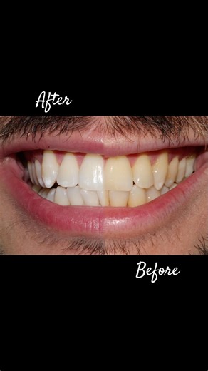 ✨ In-Office Teeth Whitening Before & After | PROMO ENDS Feb 28th #shorts #teethwhitening