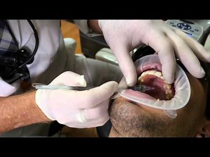 Dr. Hornbrook's "Dental Practice Enhancers": Using the Wand Pt. 2