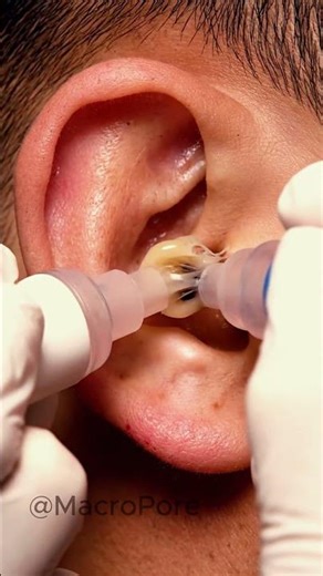 Luxury Macro Ear Blackhead Removal ✨ Vacuum ASMR #satisfying