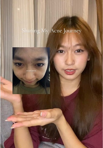 My Personal Acne Journey and Recommendations