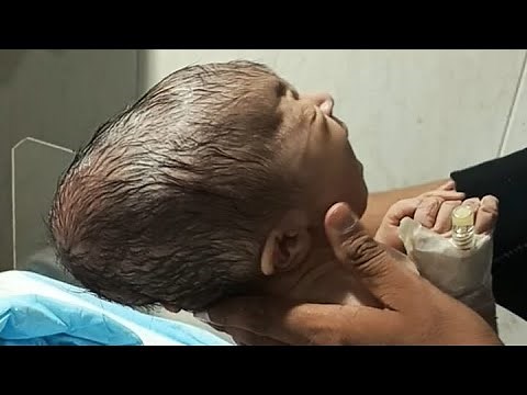 Hydrocephalic Baby Assessment | Head to Toe Examination in NICU