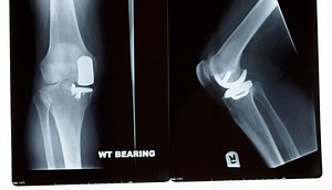 Partial Knee Replacement in Singapore | Oxford Orthopaedics