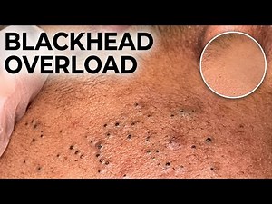Korean Skincare Routine - THE ULTIMATE GUIDE | Deep Cleansing & Blackhead Removal