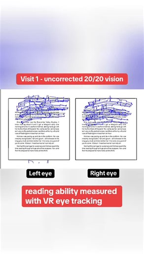 Vivid Visions Optometry, Inc | Look at the dramatic transformation in eye tracking I see in my patients when reading—visit 1 with 20/20 vision, then 4 weeks later, then 3... | Instagram