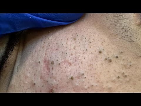 Acne Treatment Mistakes You're Probably Making Right Now