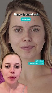 2.5K views | Chloe shows us her favorite Proactiv routine to even tone & texture while restoring her skin’s moisture barrier - SHOP: https://tinyurl.com/mwx9h958 | Proactiv | Facebook