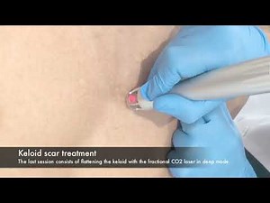 Dr. Didac Barco - Keloid scar treatment