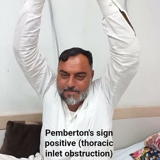 Pemberton's sign: Development of facial congestion after raising arms in thoracic inlet obstruction.
