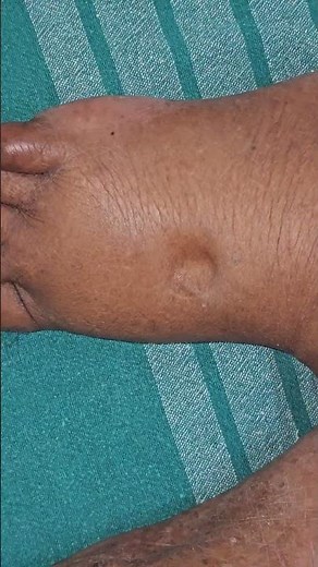 Bilateral Pitting Pedal Edema #imwell #education #bangalore #health