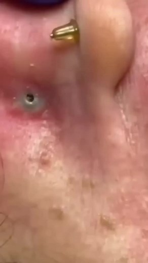 Nose Cleaning Procedure: Satisfying Pimple Popping