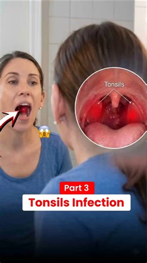 Sirf Do Tonsils Nahi Hote! | Tonsils Ke Types Explained (Part 3) #shorts #shortfeed #tonsils