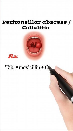 peritonsillar abscess treatment