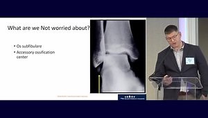 Fractures Involving the Distal Tibial Physis or Focusing on "Transitional" Ankle Fractures