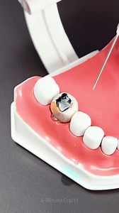 5-Minute Repair on Instagram: "A step-by-step look at restoring a rotten tooth"