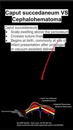 Caput succedaneum VS Cephalohematoma
