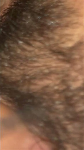#blackheadcaique #pimple #oddlysatisfying #thebarbersarms #satisfying #beard #blackheads